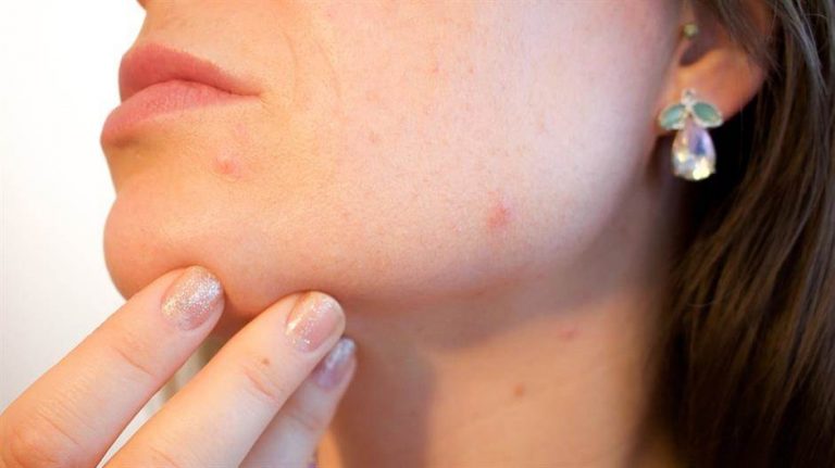 Dermatolozi: Ovo će vas riješiti mitesera i oni se neće vraćati